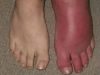 What Does It Mean When One Leg Suddenly Turns Red and Swollen?