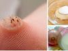 Simple Remedies to Eliminate Warts Naturally
