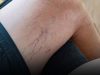 Leg Veins Turning Purple? Here’s What You Need to Know