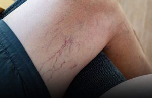 Leg Veins Turning Purple? Here’s What You Need to Know