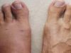Swollen feet: a sign you shouldn’t ignore
