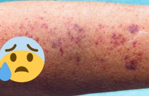Purple blotches keep showing up on my arms. Doctor isn’t available for weeks. What should I do?