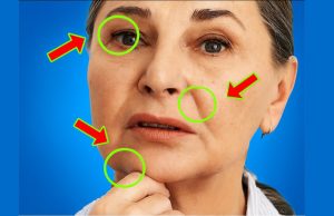 Everyone with fatty liver has this in common! A hidden sign you should know about.